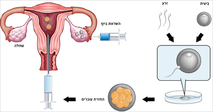 תרשים להמחשת תהליך הפריה חוץ גופית IVF