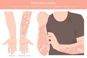 אורטיקריה